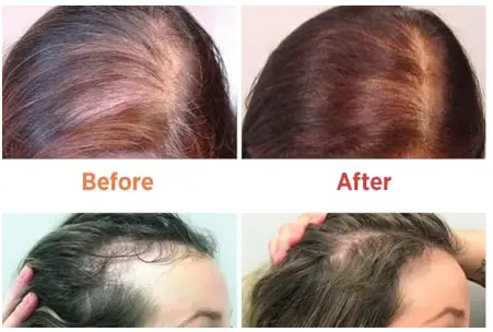 This £17 Amazon hair growth serum gives 'visible results' in 2 weeks, say  shoppers - Manchester Evening News