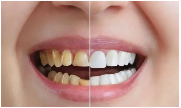 9 Natural Remedies For Teeth Whitening