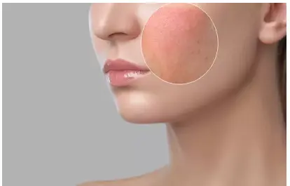 Beta-Glucans For Skin: Benefits And How To Use Beta-Glucans For Skin: Benefits And How To Use